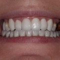 After transformation, with 6 veneers on upper arch