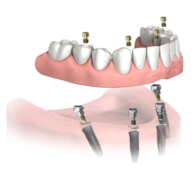 Acrylic-Titanium All-On-4 Bridge dental implant cost