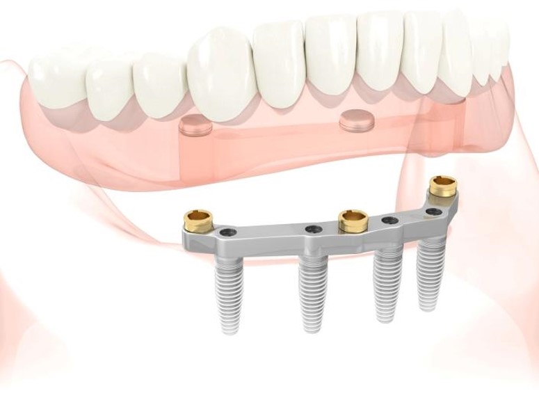 Bar Supported Denture cost