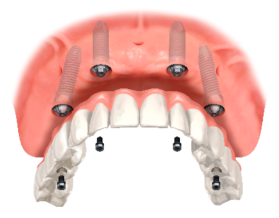 dental-implant-medical-insurance-figure-1.png
