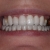 After transformation, with 6 veneers on upper arch