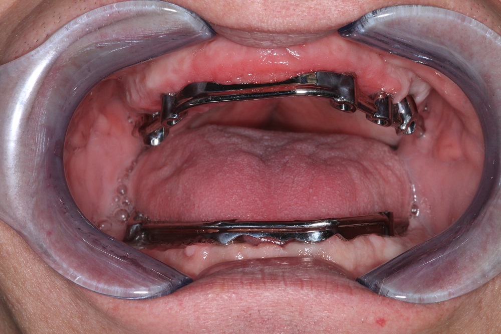 <h3>Implant Retained Bar</h3>