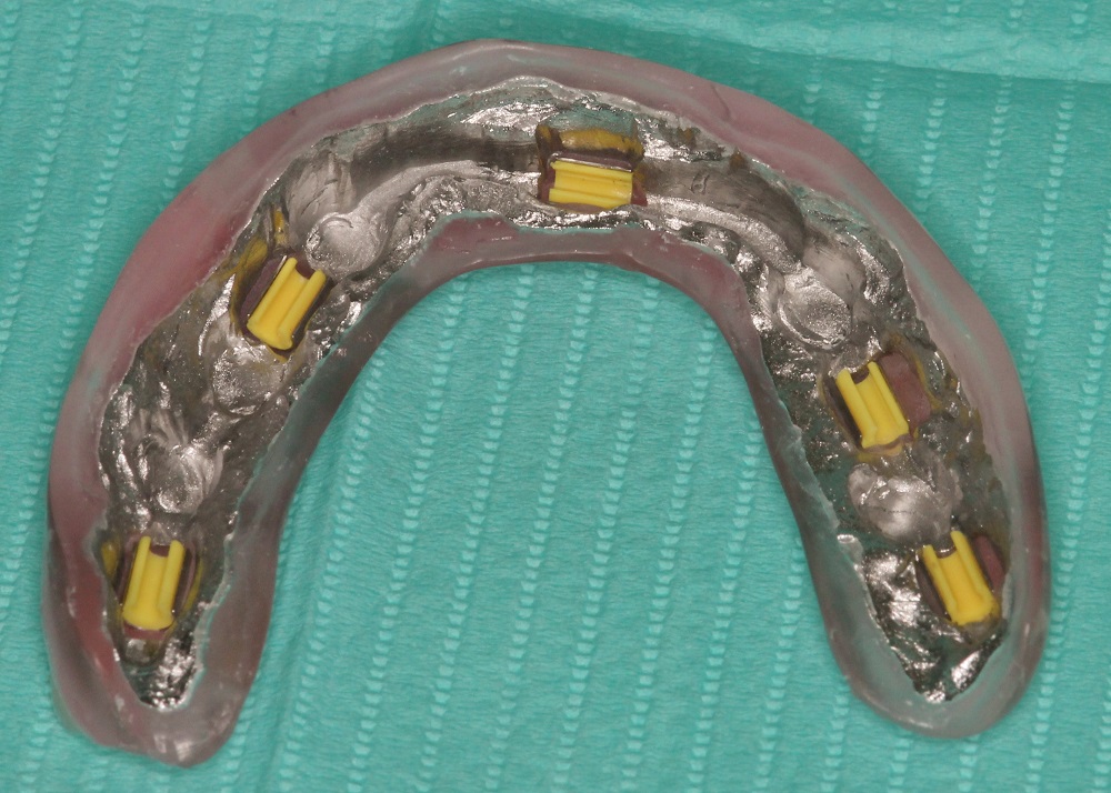 <h3>Attachment View of Denture</h3>