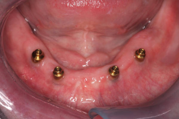 10-tips-for-long-term-success-of-removable-implant-retained-dentures-figure-1.png