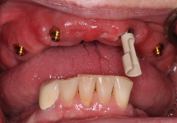 10-tips-for-long-term-success-of-removable-implant-retained-dentures-figure-12.png