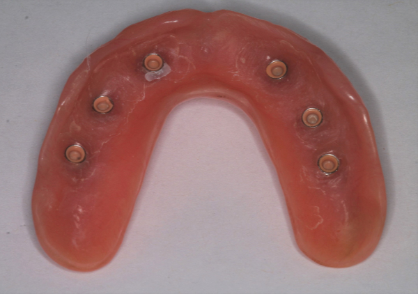 10-tips-for-long-term-success-of-removable-implant-retained-dentures-figure-16.png