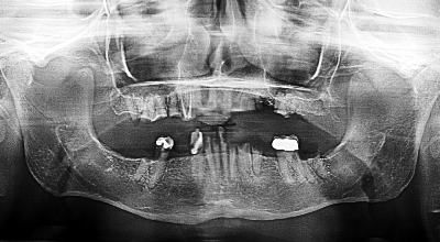 dental-implant-medical-insurance-figure-3.png
