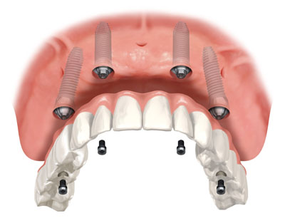 full mouth dental implant