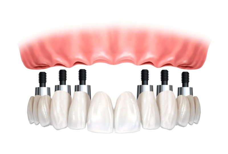 Porcelain Fused To Metal Bridge dental implant cost