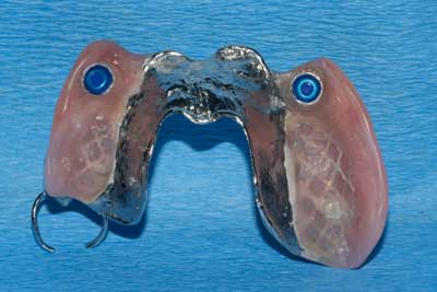 removable-partial-dentures-implant-supported-locator-figure-6.png